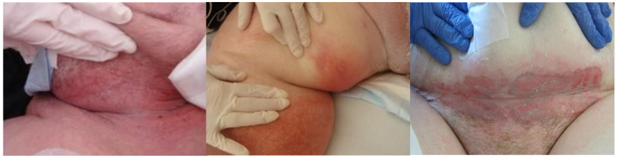 Figure 2: Intertriginous Dermatitis of the neck, behind the knee and abdomen. The abdominal case is more extensive with crusting