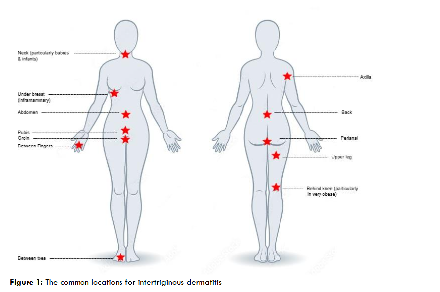 Figure 1: The common locations for intertriginous dermatitis