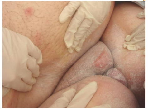 Figure 5: The examiner will need assistance to move skin folds in the morbidly obese patient