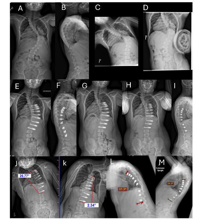 Fig. 1A-M. Example of unilateral instrumented thoracic curve over a period of 60 months postoperative. See Section 3.2 Case History for Figure 1.