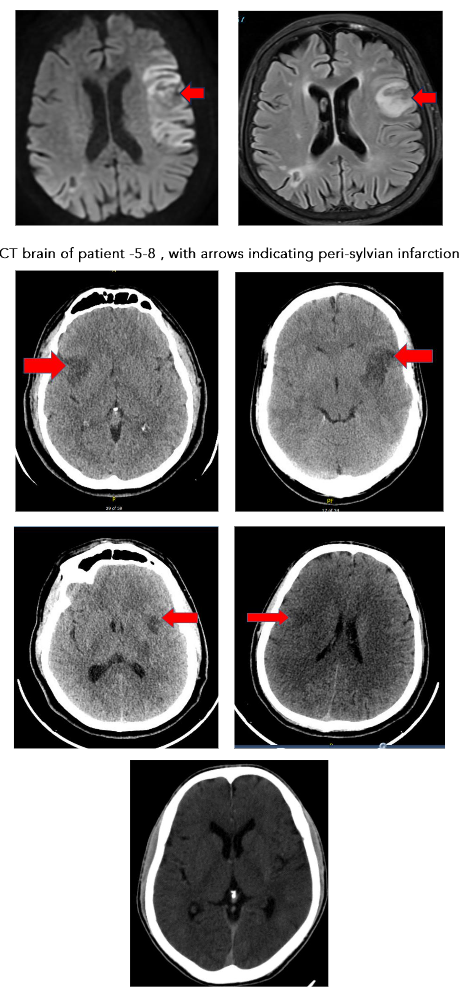 CT brain of patient 10, who presented with loss of bladder presentation and CT showing infarction