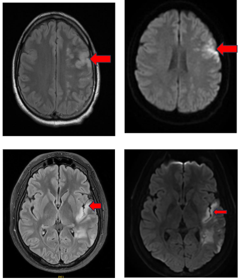 MRI of patient 1 - with arrow indicating peri-sylvian infarction