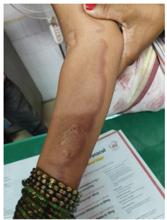 Figure 1: Skin rash on the arm