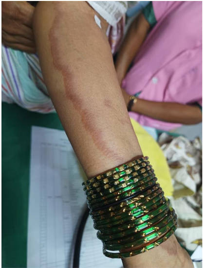 Figure 2: Skin rash on the abdomen