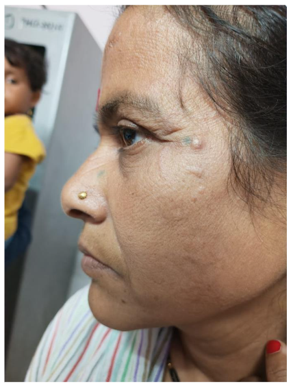 Figure 3: Skin lesions on the face