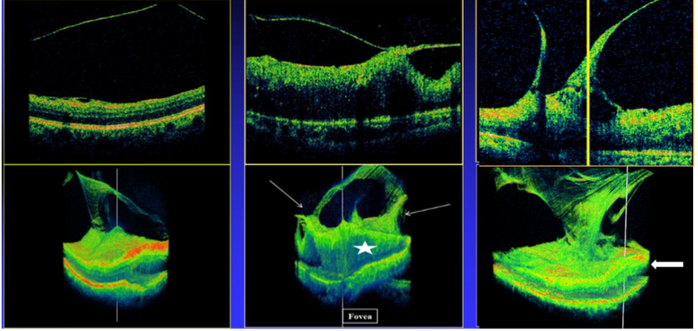 Figure 1: Diffuse diabetic macular edema related to extrafoveal vitreomacular traction (left and central columns) and vitreopapillary traction (right), detected by 3D SD-OCT. Upper row: B-scans OCT. Eyes 1 and 2 (left and central): The posterior hyaloid (PH) in Eye 1 (left) is away from the mildly thickened macula in this area (ERM is also detected). In Eye 2 (center), one vitreomacular extrafoveal traction site is presented. The corresponding 3D images (lower row) present diffuse macular edema (central figure, star) in each, secondary to at least two extrafoveal traction membranes in each (central figure, arrows); the traction sites are located peripherally at the 6X6 mm2 scan areas. Eye 3 (right): B-scan presents vitreopapillary traction and adjacent retinal thickening; the corresponding 3D image shows the associated diffuse DME (arrow). All three foveae, marked by vertical lines in the 3D figures, are free from traction. If only OCT B-scans were undertaken, and more so if raster or radial lines were used, each eye could be destined to hopeless repeated intravitreal injections of various medications and to GLPs for months and years.