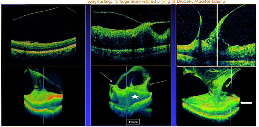 Figure 1: Diffuse diabetic macular edema related to extrafoveal vitreomacular traction (left and central columns) and vitreopapillary traction (right), detected by 3D SD-OCT. Upper row: B-scans OCT. Eyes 1 and 2 (left and central): The posterior hyaloid (PH) in Eye 1 (left) is away from the mildly thickened macula in this area (ERM is also detected). In Eye 2 (center), one vitreomacular extrafoveal traction site is presented. The corresponding 3D images (lower row) present diffuse macular edema (central figure, star) in each, secondary to at least two extrafoveal traction membranes in each (central figure, arrows); the traction sites are located peripherally at the 6X6 mm2 scan areas. Eye 3 (right): B-scan presents vitreopapillary traction and adjacent retinal thickening; the corresponding 3D image shows the associated diffuse DME (arrow). All three foveae, marked by vertical lines in the 3D figures, are free from traction. If only OCT B-scans were undertaken, and more so if raster or radial lines were used, each eye could be destined to hopeless repeated intravitreal injections of various medications and to GLPs for months and years.