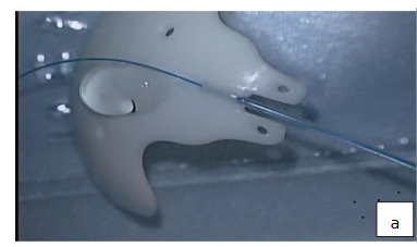 Figure 1a: ACP with 5/0 nylon ripcord in lumen. Priming ACP by flushing with BSS.