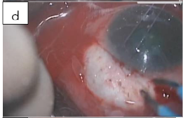 Figure 2d: Blunt dissection extended posteriorly.