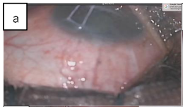 Figure 2a: Corneal traction with 6/0 vicryl after the routine cleansing draping and eyelid opening with speculum.