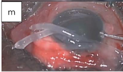 Figure 2m: Subconjunctival injection of Genticin and Dexamethasone.