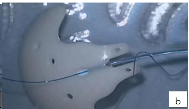 Figure 1b: ACP ligated with 7/0 Vicryl suture.