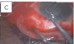 Figure 2c: Blunt dissection using Westcott and conjunctival forceps.