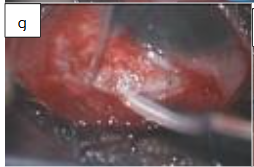 Figure 2g: Plates secured at 8mm or 9mm from the limbus.