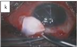Figure 2k: Tubes covered with scleral or cornea graft.