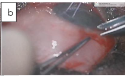 Figure 2b: Fornix based conjunctival peritomy.