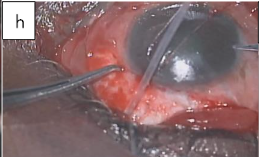 Figure 2h: Paracentesis created with 150 and a 23gauge needle.