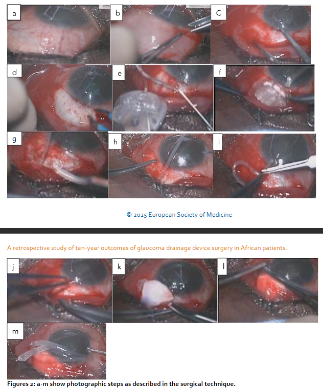Figure 1b: ACP ligated with 7/0 Vicryl suture.