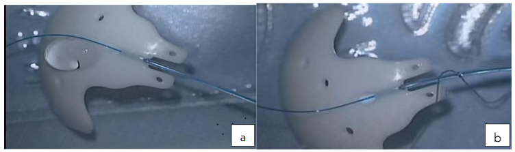 Figure 1a: ACP with 5/0 nylon ripcord in lumen. Priming ACP by flushing with BSS.