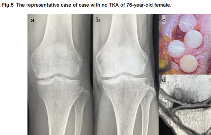 The representative case of case with no TKA of 76-year-old female.