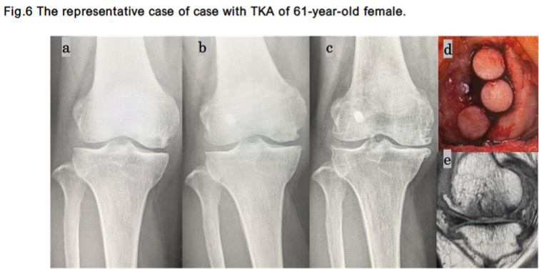 The representative case of case with TKA of 61-year-old female.
