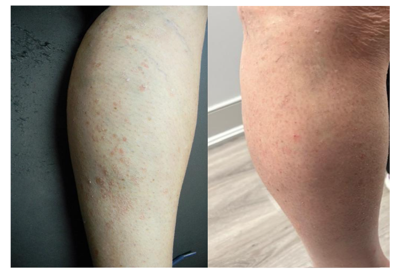Figure 1. Patient’s psoriatic skin lesions on the right leg one year after MSCs treatment.