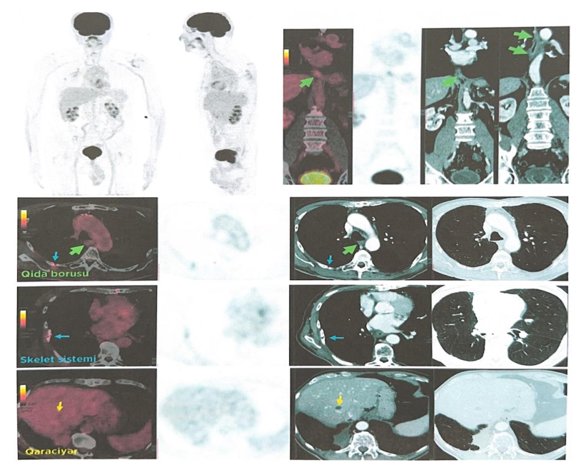September 16, 2016: Post-lobectomy and lymph node dissection, serial ^18F-FDG PET/CT initiated to monitor for recurrence or metastasis.
