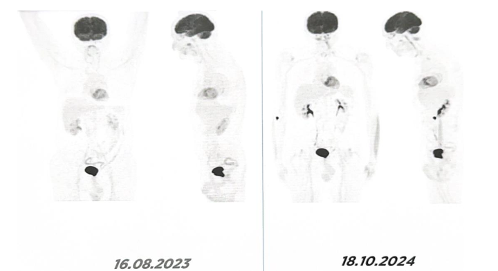 Figure 4. August 16, 2023, and October 18, 2024: Follow-up ^18F-FDG PET/CT confirmed continued absence of recurrence or metastasis.