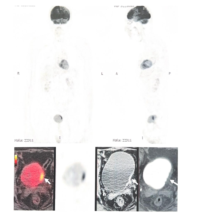 Figure 3. Imaging of the bladder wall post-TURBT and BCG therapy showed no residual disease or recurrence.