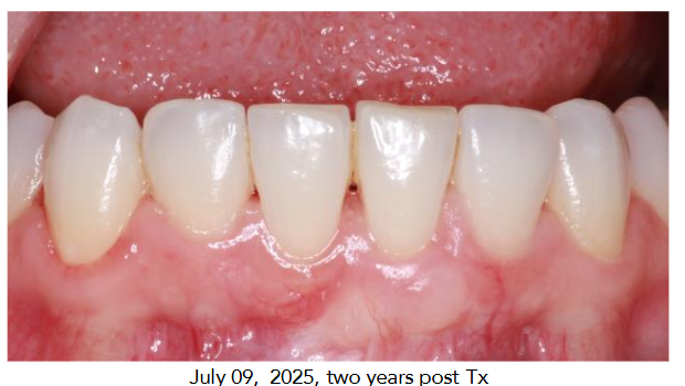 July 09, 2025, two years post Tx