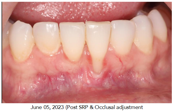 June 05, 2023 (Post SRP & Occlusal adjustment)