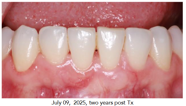 July 09, 2025, two years post Tx