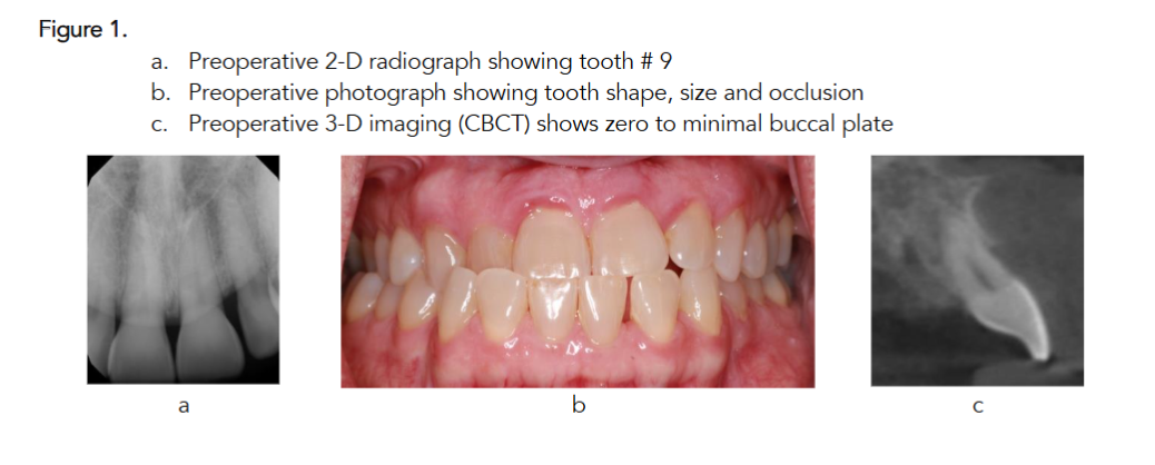 Figure 1. a. Preoperative 2-D radiograph showing tooth # 9 b. Preoperative photograph showing tooth shape, size and occlusion c. Preoperative 3-D imaging (CBCT) shows zero to minimal buccal plate