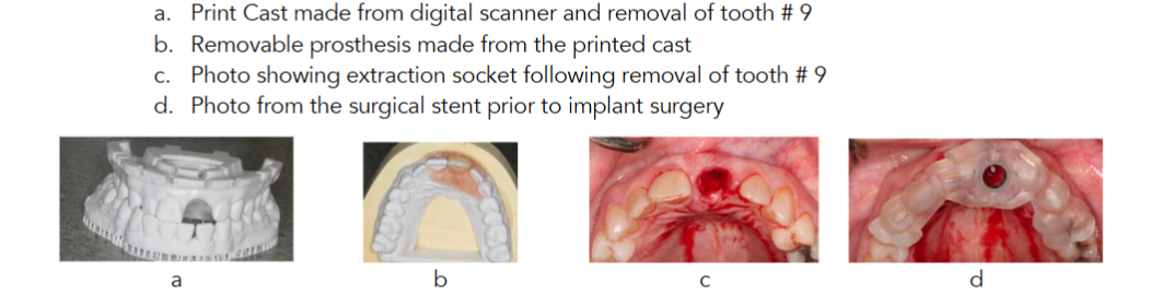 Figure 2. a. Print Cast made from digital scanner and removal of tooth # 9 b. Removable prosthesis made from the printed cast c. Photo showing extraction socket following removal of tooth # 9 d. Photo from the surgical stent prior to implant surgery