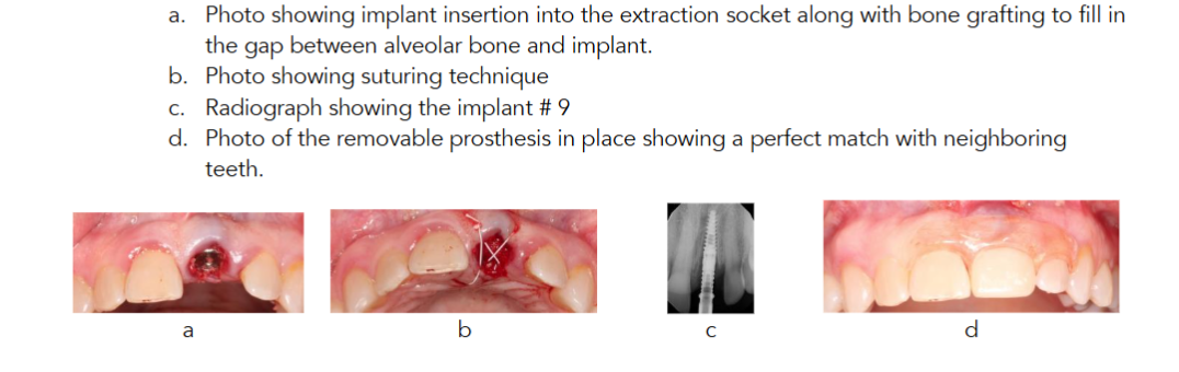 Figure 3 a. Photo showing implant insertion into the extraction socket along with bone grafting to fill in the gap between alveolar bone and implant. b. Photo showing suturing technique c. Radiograph showing the implant # 9 d. Photo of the removable prosthesis in place showing a perfect match with neighboring teeth.