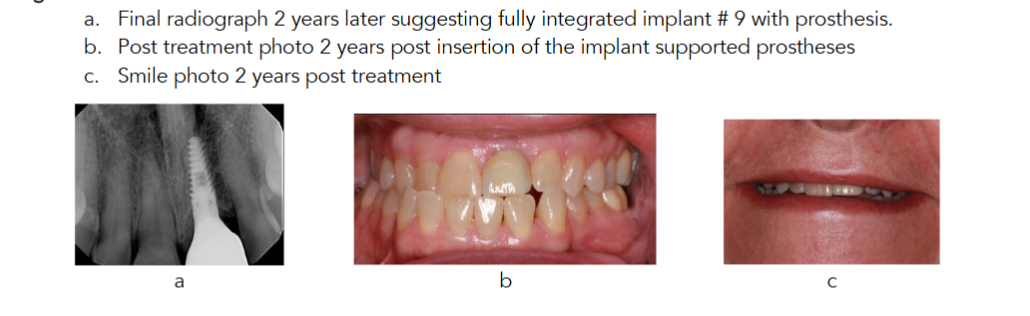 Figure 5 a. Final radiograph 2 years later suggesting fully integrated implant # 9 with prosthesis. b. Post treatment photo 2 years post insertion of the implant supported prostheses c. Smile photo 2 years post treatment