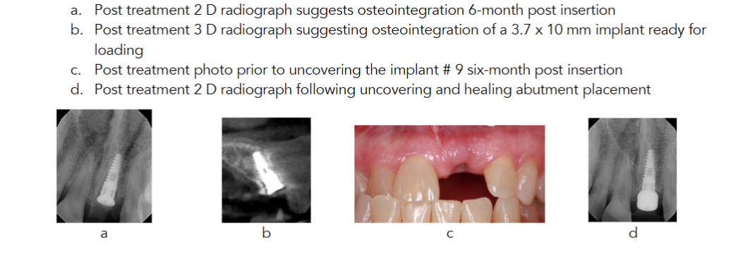 Figure 4 a. Post treatment 2 D radiograph suggests osteointegration 6-month post insertion b. Post treatment 3 D radiograph suggesting osteointegration of a 3.7 x 10 mm implant ready for loading c. Post treatment photo prior to uncovering the implant # 9 six-month post insertion d. Post treatment 2 D radiograph following uncovering and healing abutment placement