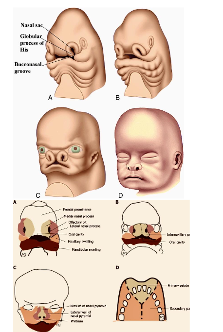 Classification of the craniofacial clefts according to Tessier; line of the bone tissue cleft is shown on the left side and line of the soft tissue cleft is shown on the right side.