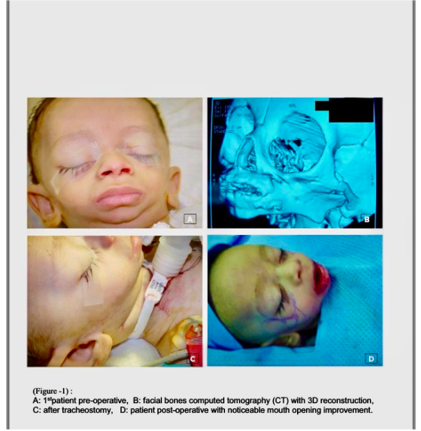 Patient post-operative with noticeable mouth opening improvement.