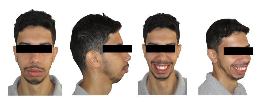 Figure 1: Pre-treatment facial photographs
