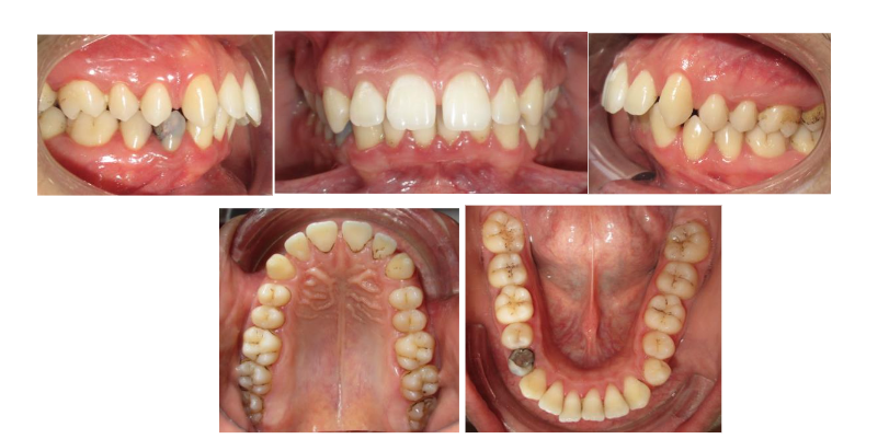 Figure 2: Pre-treatment intra-oral photographs