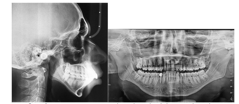 Figure 3: Pre-treatment panoramic radiograph and cephalometric radiograph.