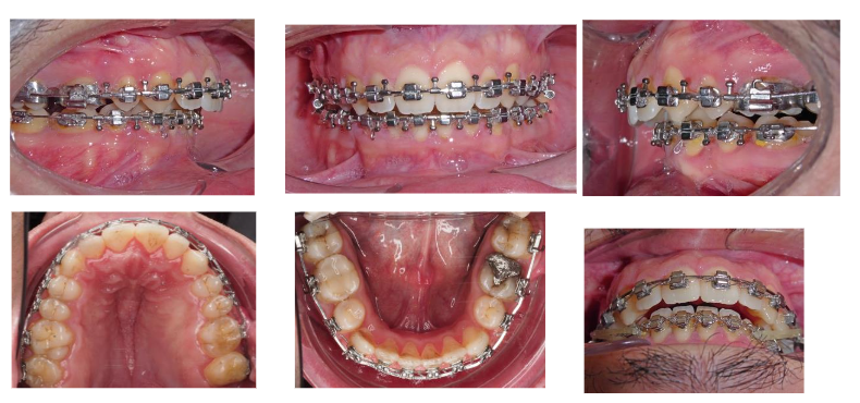 Figure 5: Pre-surgical intra-oral photographs.