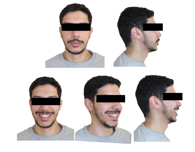 Figure 6: Post-treatment intra-oral photographs.