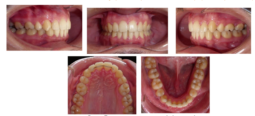 Figure 9: Post-treatment panoramic radiograph and lateral cephalogram.