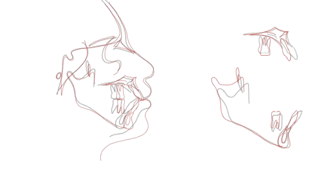 Figure 10: Cephalometric superimposition (post-treatment).