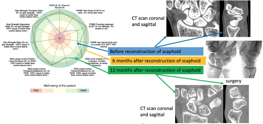 Figure 3a and 3b: The consensus wrist index for case 3.