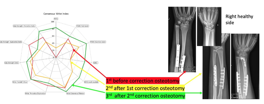 Figure 1a and 1b: The consensus wrist index for case 1.