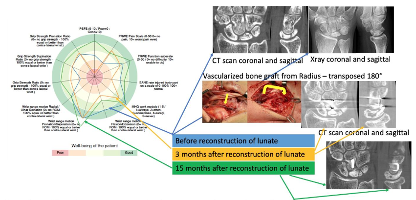 Figure 2a and 2b: The consensus wrist index for case 2.