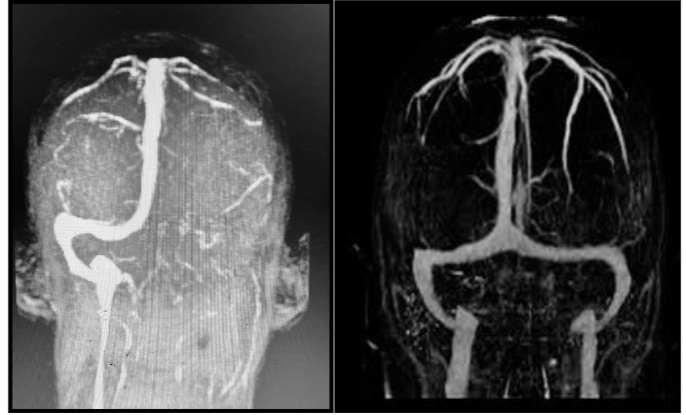 Pre-procedural CT venography revealed extensive thrombosis of the superior sagittal sinus, characterized by a lack of opacification in the affected sinus, indicating complete occlusion. Post-procedure, cerebral venous flow was successfully restored, and follow-up imaging confirmed patency of the venous sinuses.
